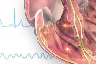 Illustration of an arrhythmia