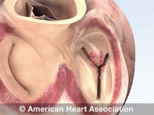 Endocarditis illustration