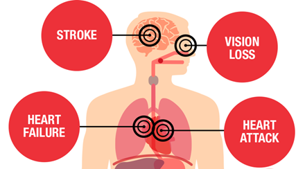 diagram of body showing health threats from high blood pressure